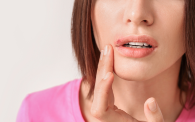 FOODS TO AVOID DURING A COLD SORE BREAK